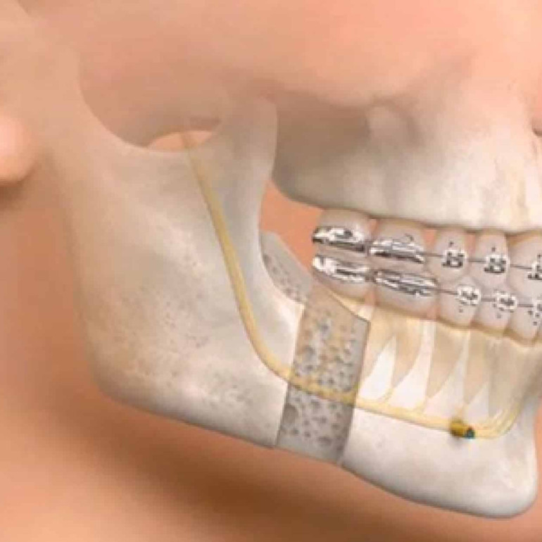 luxatii de mandibula timisoara, chirurgie maxilo faciala timisoara, chirurgie estetica timisoara, chirurg estetic timisoara, chirurg maxilofacial timisoara, injectari toxina botulinica timisoara, proceduri chirurgie maxilo-faciala timisoara, chirurgie maxilo-faciala preturi timisoara, chirurgie maxilo-faciala spitalul militar timisoara, chirurgie maxilo-faciala, chirurgie maxilo-faciala cluj, chirurgie maxilo-faciala preturi craiova, chirurgie maxilo-faciala bucuresti, anestezii chirurgie maxilo-faciala timisoara, chirurgie maxilo-faciala craiova, chirurgie maxilo-faciala preturi cluj, chirurgie orala timisoara, chirurgie dento-alveolara timisoara, implantologie conventionala timisoara, implanturi zigomatice timisoara, reconstructii osoase faciale timisoara, chirurgia tumorilor faciale timisoara, chirurgia chisturilor maxilare, chirurgia ortognata timisoara, chirurgie estetica a fetei timisoara
odontectomie timisoara, chirurgia infectiilor maxilo-faciale si cervicale.